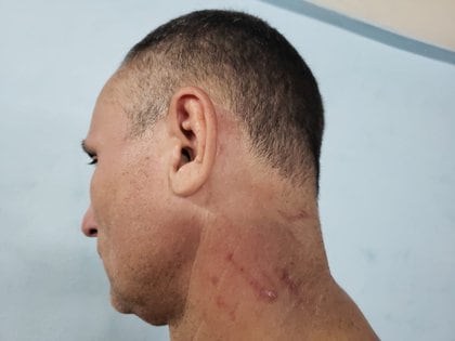 José Daniel Ferrer muestra las heridas que le causaron en el cuello agentes del régimen cubano.