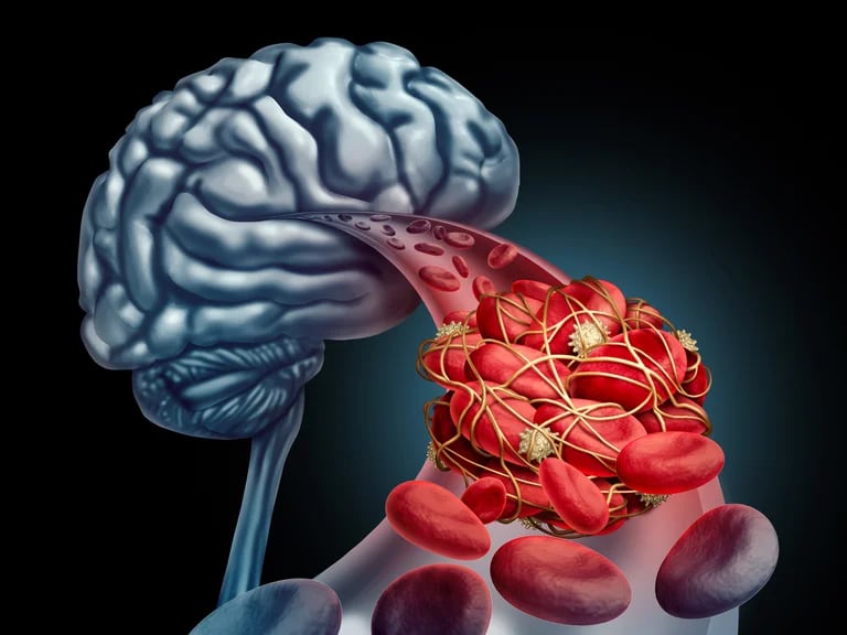 Los ataques cerebrovasculares se pueden producir cuando un vaso sanguíneo que irriga sangre al cerebro resulta bloqueado 