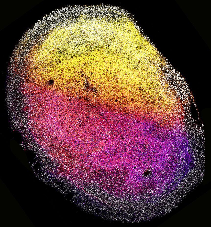 Imagen de un organoide de cerebro fetal humano completo. Las células madre están marcadas por SOX2 (gris) y las células neuronales (TUJ1) están coloreadas de rosa a amarillo en función de la profundidad. (Princess Máxima Center, Hubrecht Institute/B Artegiani, D Hendriks, H Clevers/SOLO USO EDITORIAL)