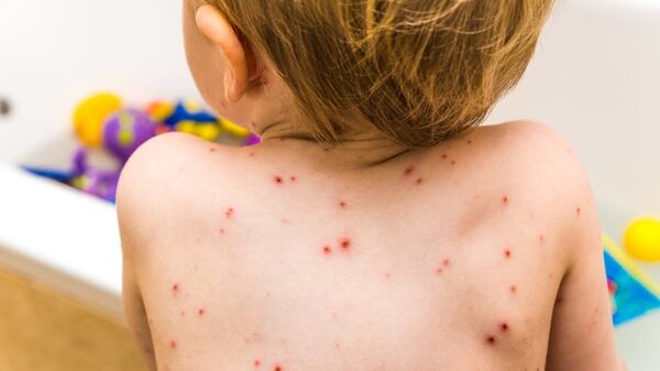 La bacteria puede irrumpir cuando existen lesiones en la piel, como en el caso de la varicela (SMG Center)