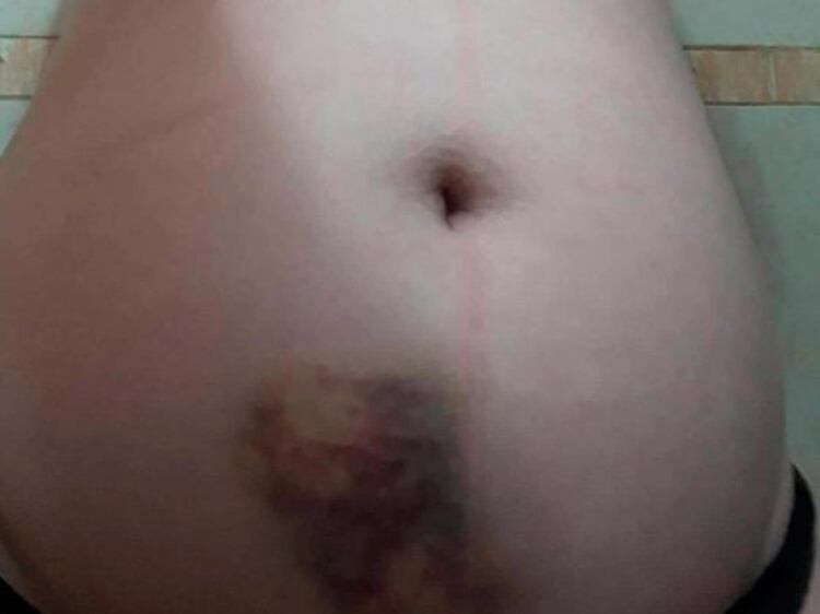 Las lesiones ocasionadas por Galante