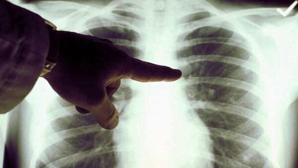 El cáncer de pulmón es una enfermedad silenciosa que cuando se detecta casi siempre es tarde para lograr una cura (iStock)