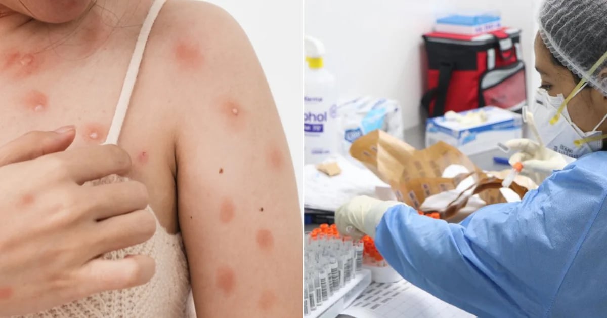 California e Illinois han declarado emergencia por el brote de viruela