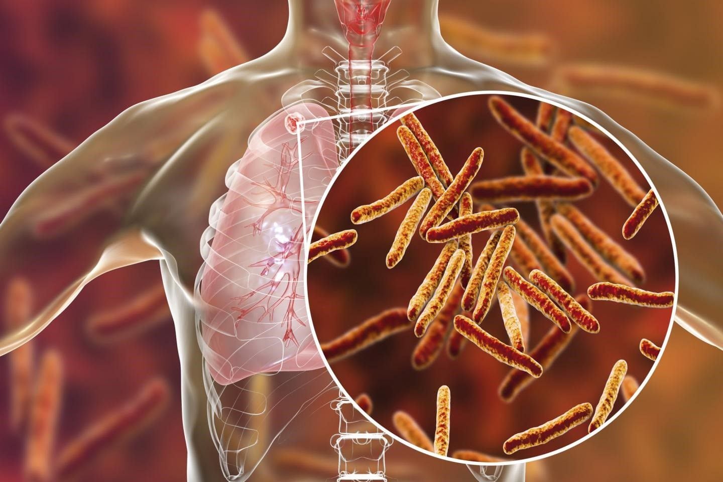 La bacteria de la tuberculosis queda alojada normalmente en el pulmón o en las zonas cercanas al pulmón que luego puede producir una infección (PENN MEDICINE)
