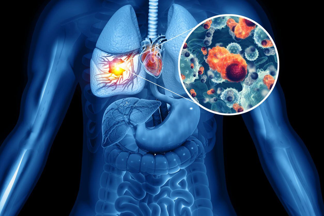 Medical Illustration showing lung cancer or bronchial carcinoma on medical background, 3d illustration  CREDIT Mohammed Haneefa Nizamudeen