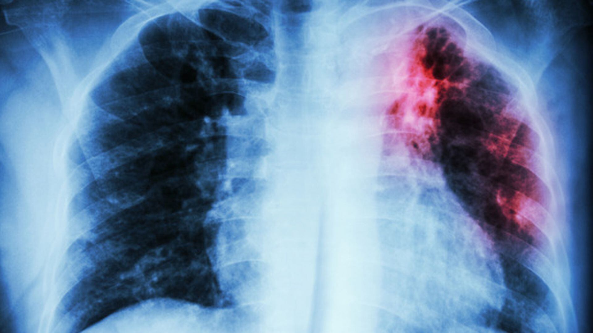 La FPI genera cicatrización del tejido pulmonar, con lo cual se torna grueso y rígido / (Istock)