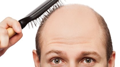 About 79 percent of men with severe COVID-19 have androgenic alopecia, compared to a range of 31 to 53 percent expected for men of the same age.