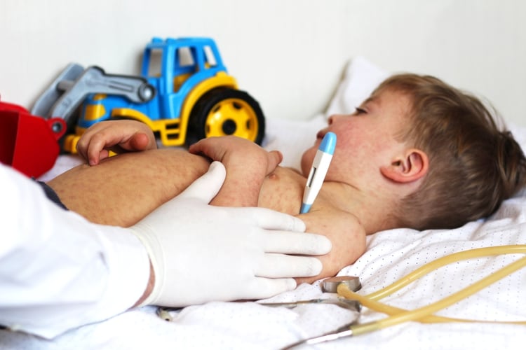 El principal factor de riesgo del sarampión es no estar vacunado (Shutterstock)