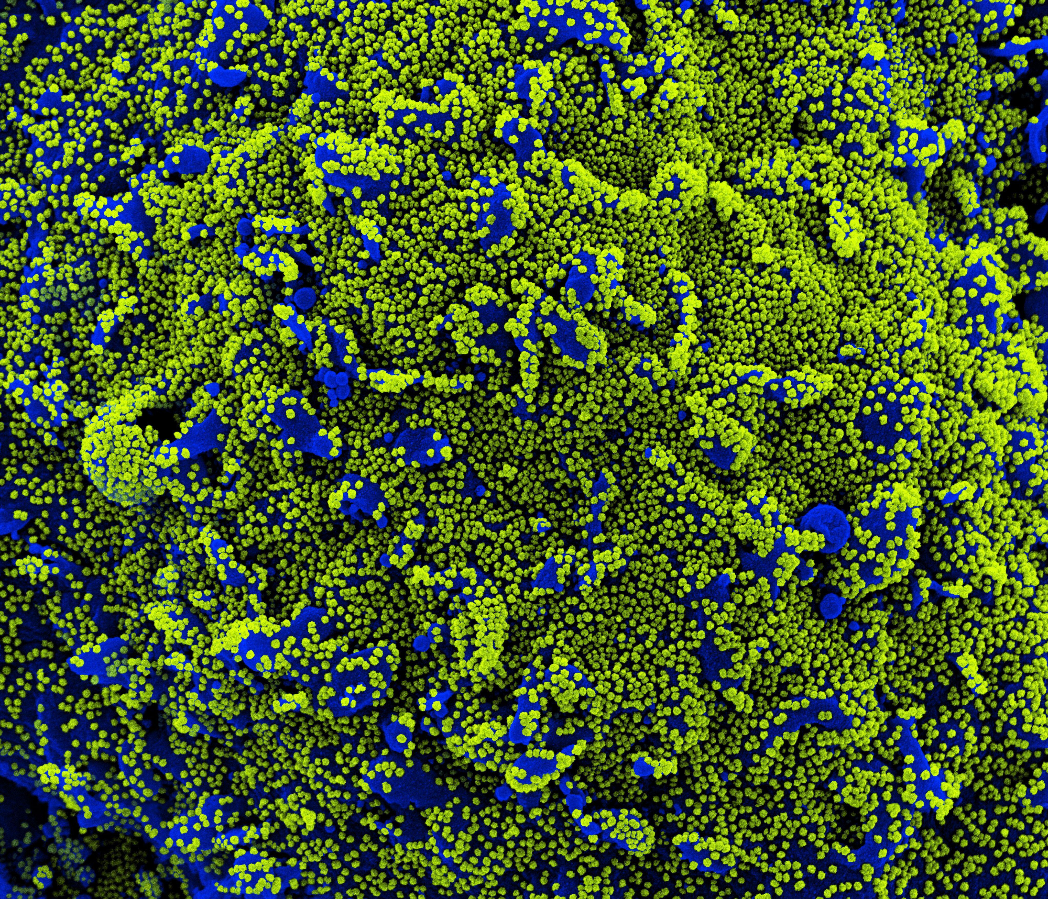 Células en azul se muestran infectadas con el coronavirus bajo el microscopio electrónico - NIAID