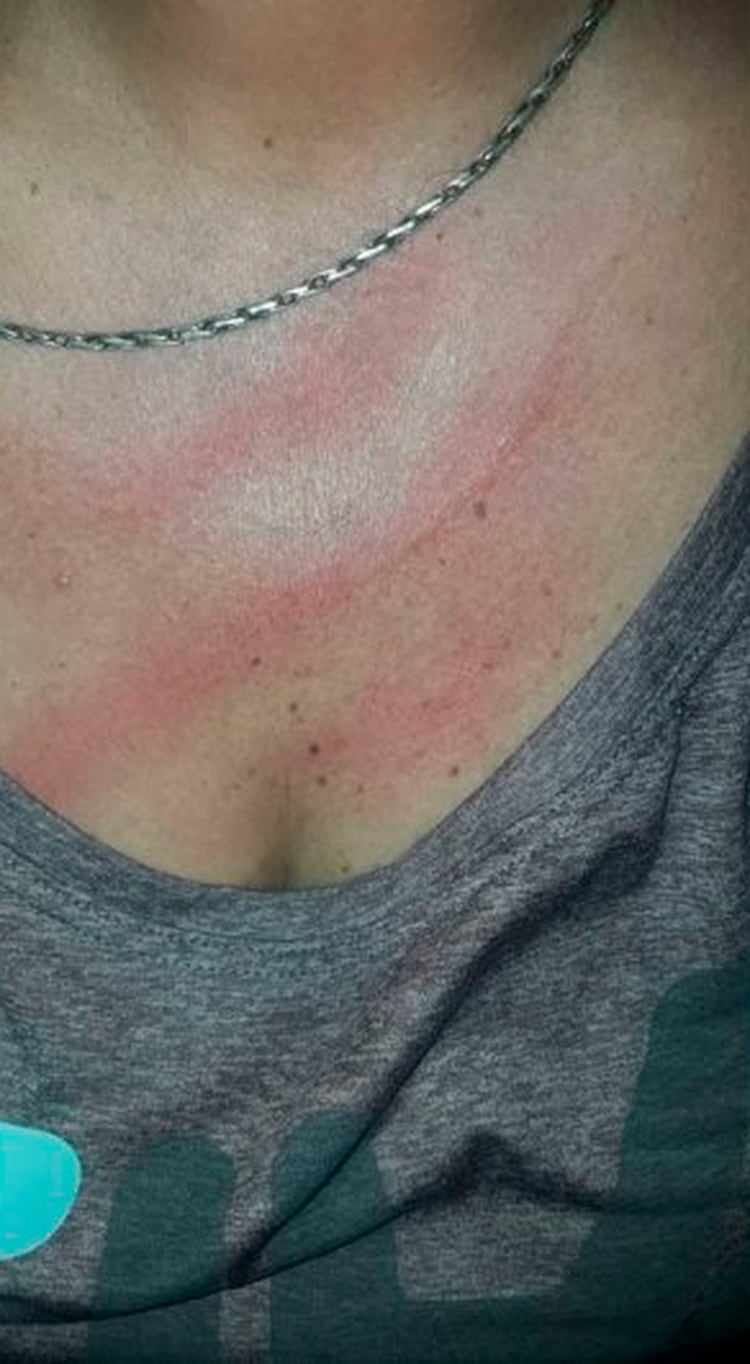 La locutora compartió fotos de las marcas en su cuerpo tras la agresión 