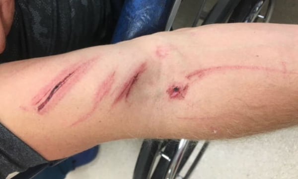 Las heridas que recibió Corey Chubon en su brazo