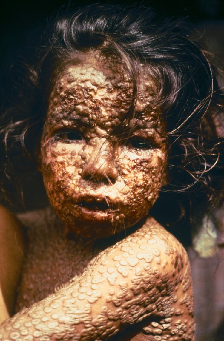 Niño con viruela (Bangladesh, 1973).