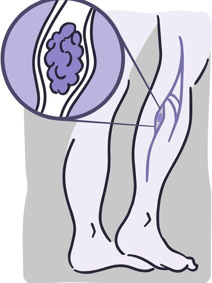 Una representación de un caso de trombosis en una pierna