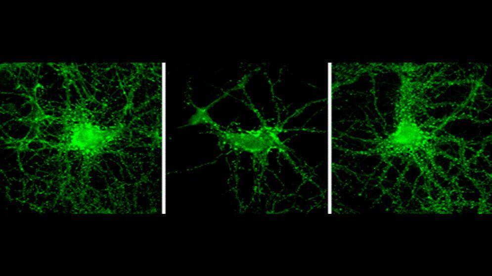 Alzheimer En estudios experimentales con neuronas aisladas, la pérdida de espinas dendríticas (centro) causada por los AβO (proteínas tóxicas del Alzheimer) se impide gracias al anticuerpo artificial NUsc1 (derecha). Diana Jerusalinsky