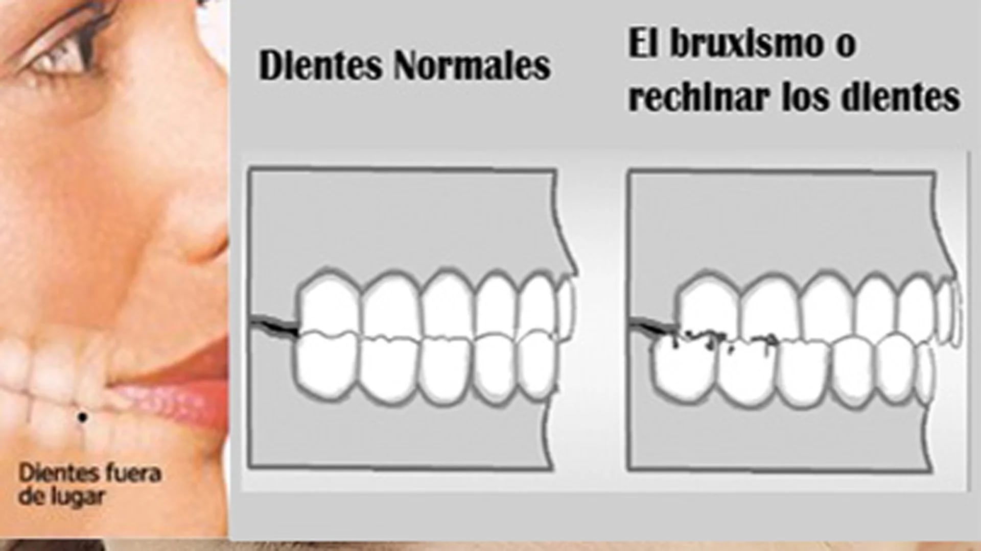 Bruxismo, Realidades y Mitos - Clínica Dental DAS Group Argentina