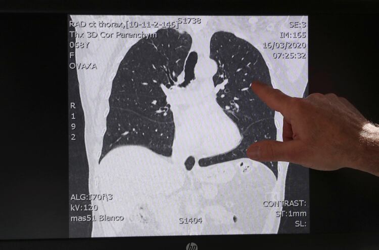El doctor belga Ignace Demeyer, presidente del Departamento de Medicina de Emergencia del Hospital Onze Lieve Vrouw, señala una imagen del escáner de los pulmones de un paciente con buena salud (exploración tomada el 16 de marzo de 2020) en Aalst, Bélgica (Reuters)