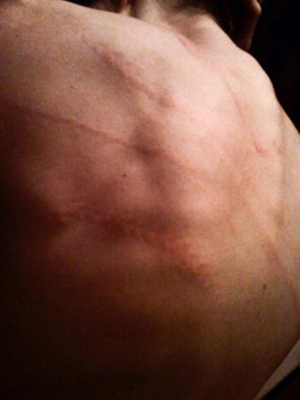 Esmé Bianco mostró las cicatrices que le quedaron en la espalda mientras filmaba un video musical para Marilyn Manson 