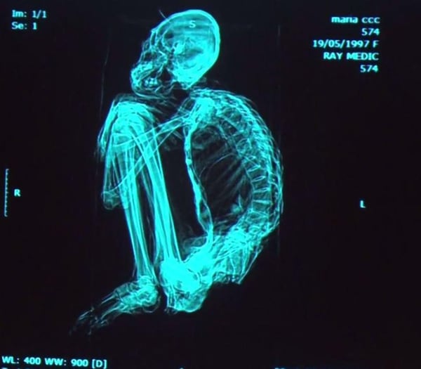 Algunas pruebas de ADN determinaron que son humanos, otras no fueron concluyentes