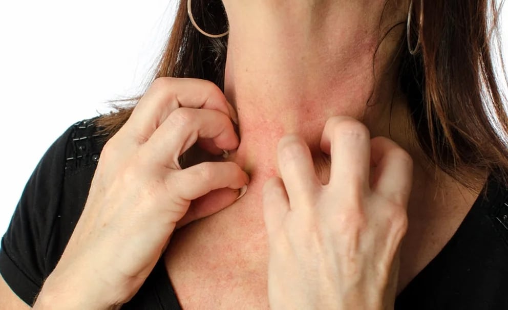 La Dermatitis Atópica es enfermedad crónica y multifactorial de la piel, cuyo principal síntoma es la picazón permanente 