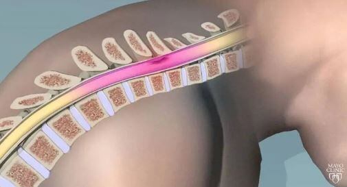 Gentileza Mayo Clinic - médula espinal