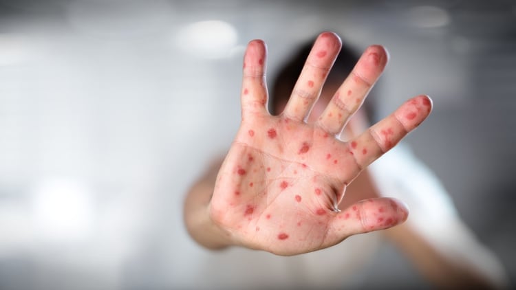 Las epidemias de sarampión eran frecuentes hace unas décadas y, en 2016, se había declarado la erradicación de esta enfermedad en las Américas (Getty)