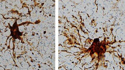 Las células 'zombis' cobran vida después de la muerte del cerebro humano. (Imagen: Dr. Jeffrey Loeb / UIC).
