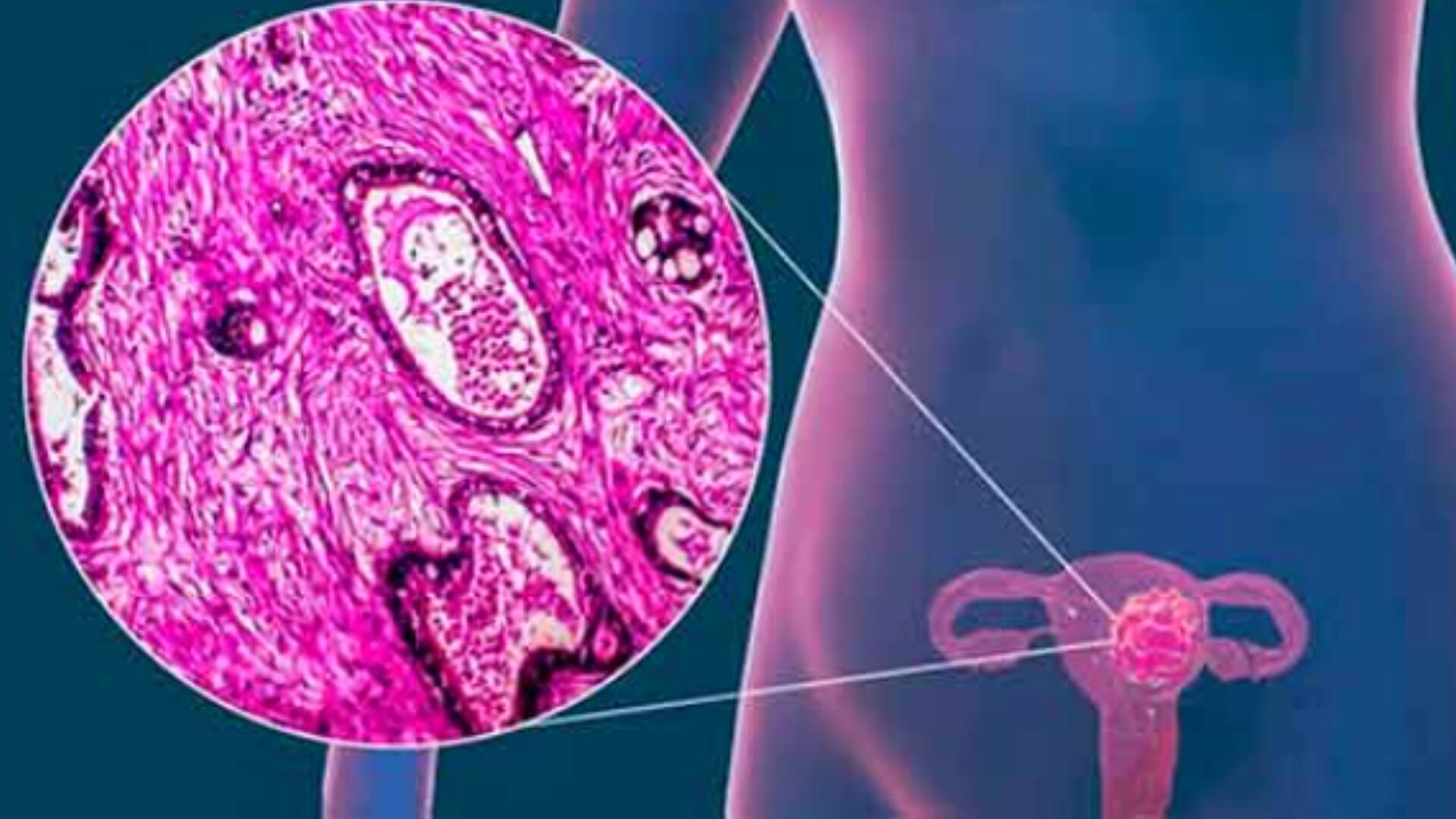 El Cáncer cervicouterino puede desarrollarse debido al Virus del Papiloma humano y otros factores modificables como el consumo de tabaco. (UNAM).