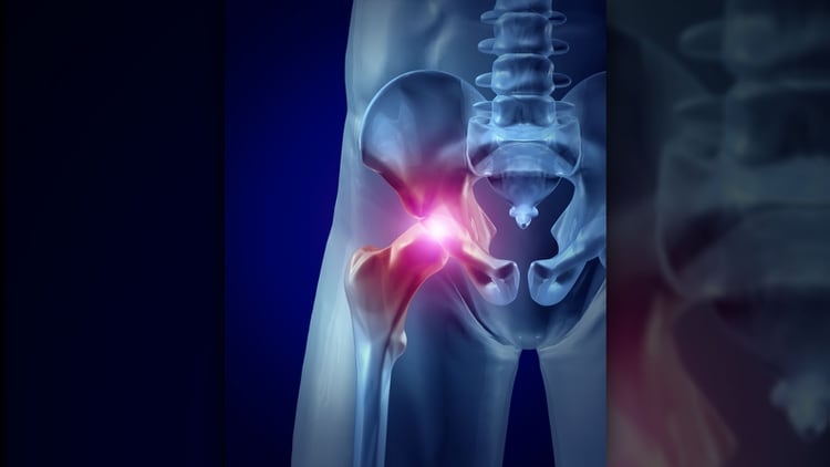  Una típica lesión de cadera (Shutterstock)