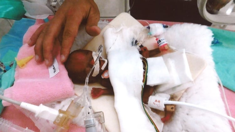 El bebé cuando estaba en su etapa más delicada en el hospital. (AFP)