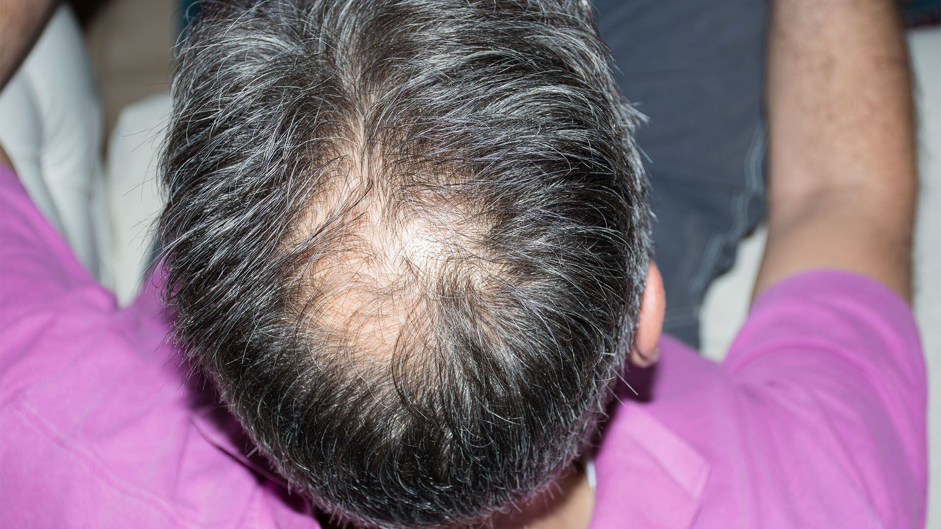 alopecia caida del cabello