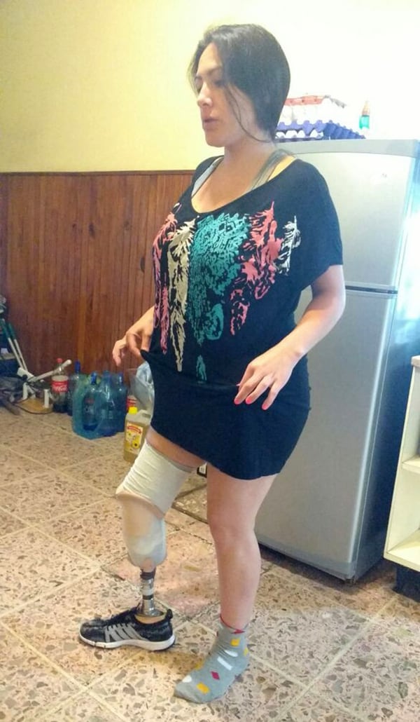 Mariela está haciendo un tratamiento de rehabilitación y probando una prótesis