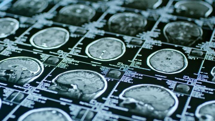 Los expertos evaluaron la corteza cerebral, desde sus medidas hasta su volumen Crédito: UNIVERSITY OF MISSOURI 
