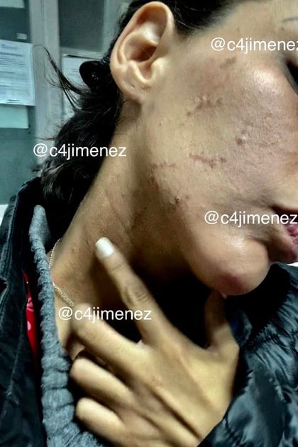El periodista Carlos Jiménez documentó las heridas que presentaba Stephanie Valenzuela (Foto: Twitter @C4Jimenez)