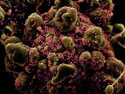 Micrografía electrónica de barrido coloreada de una célula apoptótica (marrón verdoso) muy infectada con partículas del virus SARS-COV-2 (rosa)  (NIH/Handout via REUTERS)