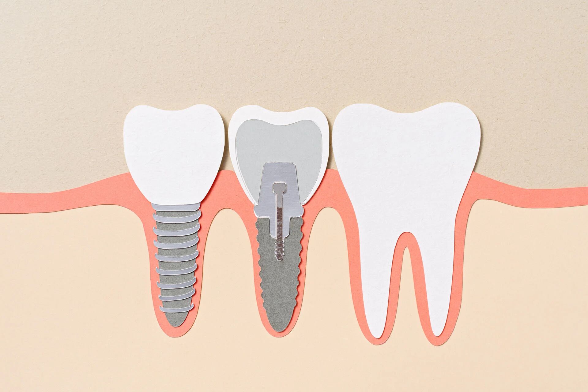 Los implantes dentales también son onerosos (Getty)