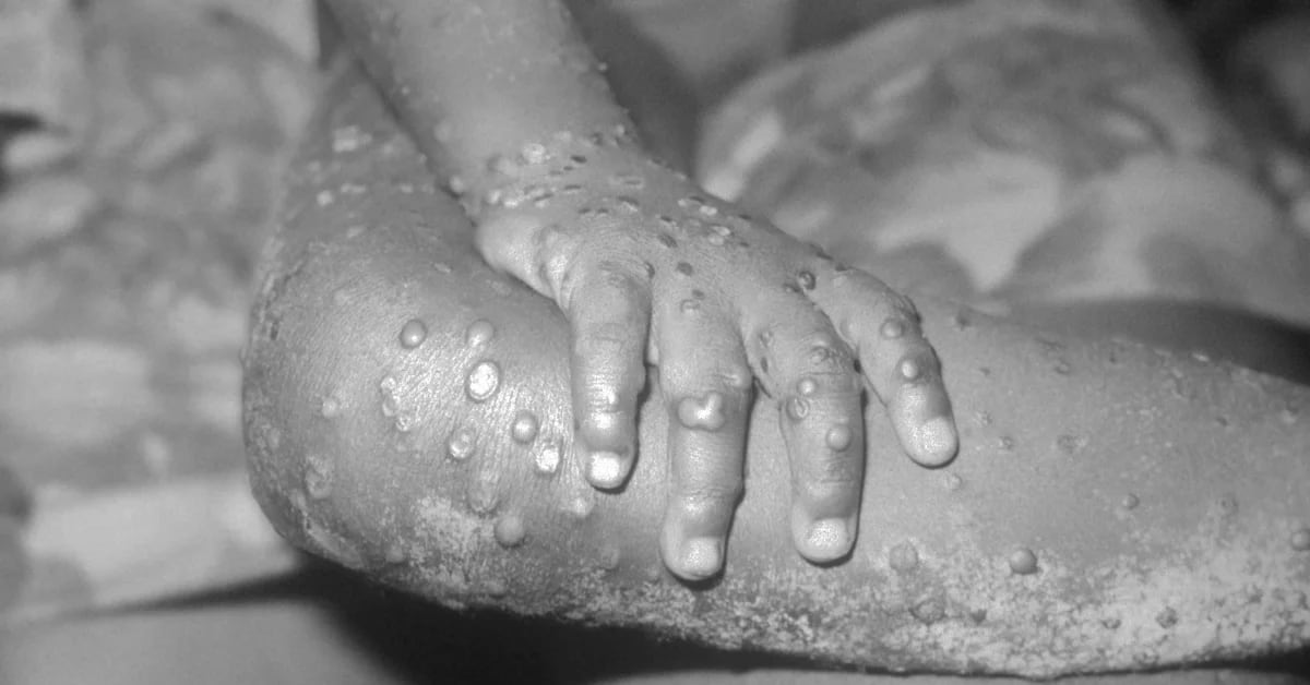 Jalisco reported two new cases of monkeypox;  There are 11 infected people in the state