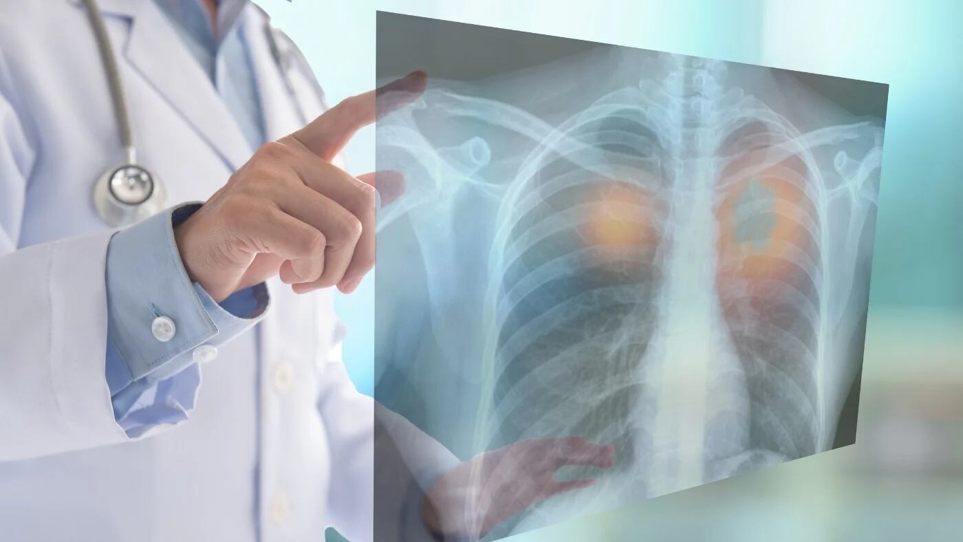 Radiografía de un pulmón (Europa Press)