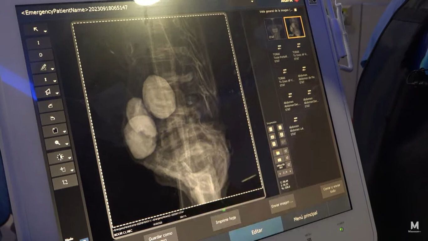 En los rayos X no aseguraron o negaron que se tratara de huevos dentro de los cuerpos no humanos (YouTube/Maussan TV)