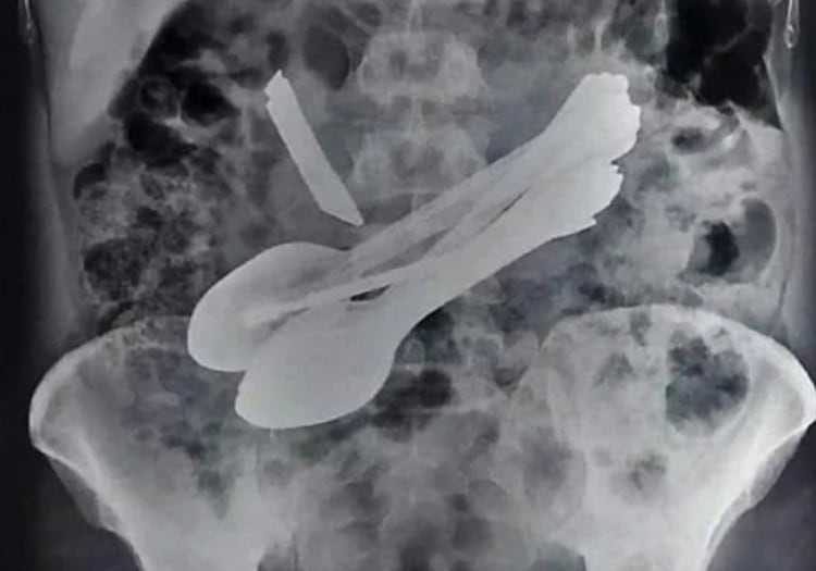 La radiografía que le tomaron al hombre (Foto: SWNS)
