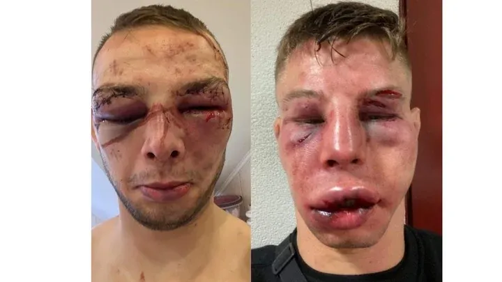 Dos luchadores terminaron con el rostro destrozado tras una brutal pelea