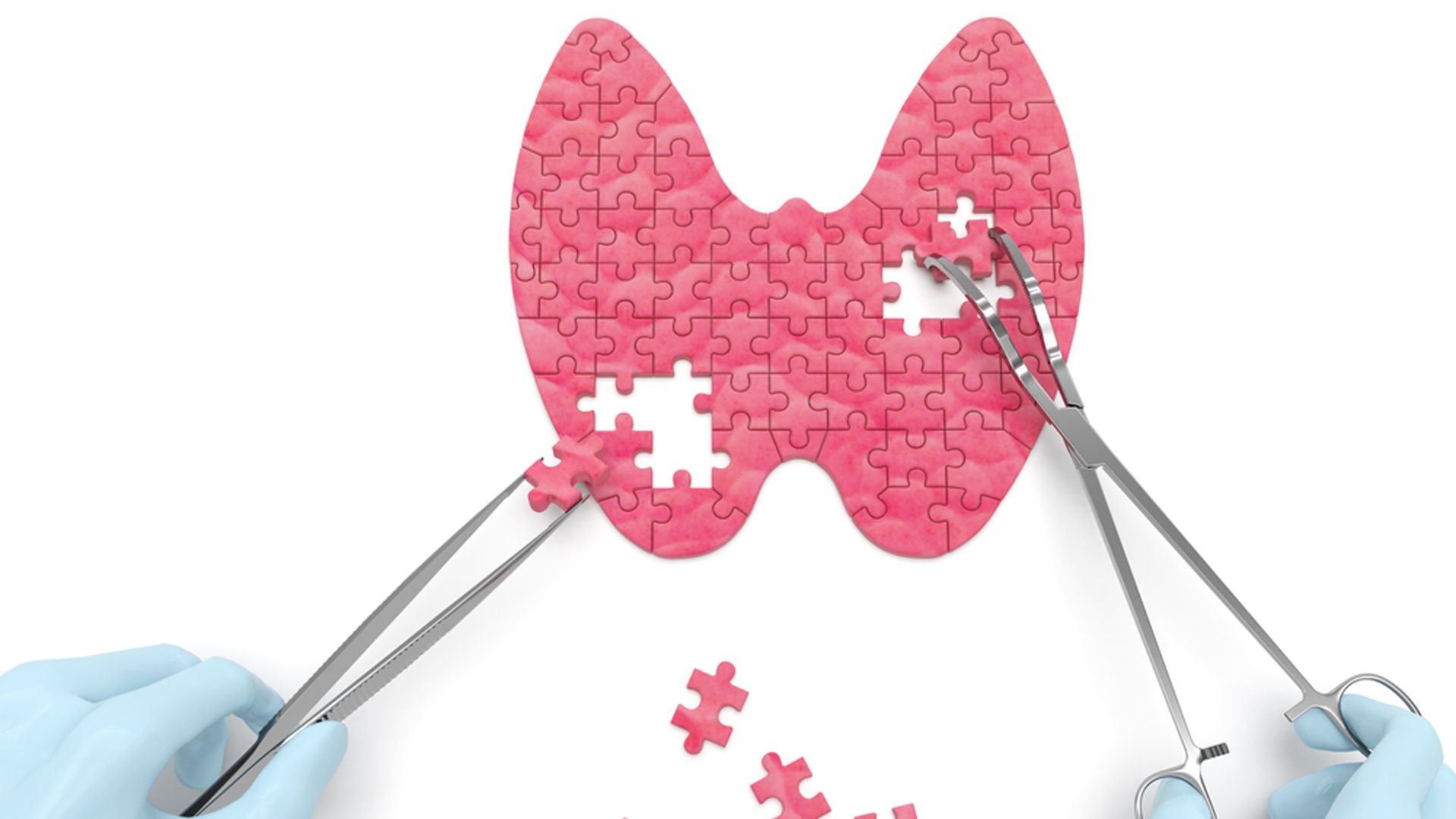 La disfunción de la glándula tiroides y el hipotiroidismo son patologías endocrinológicas comunes, con causas que van desde la predisposición genética hasta la baja ingesta de yodo