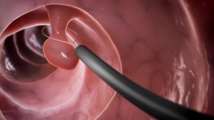 La colonoscopía es el estudio de mayor precisión y efectividad para detectar el cáncer de colon y recto (Shutterstock)