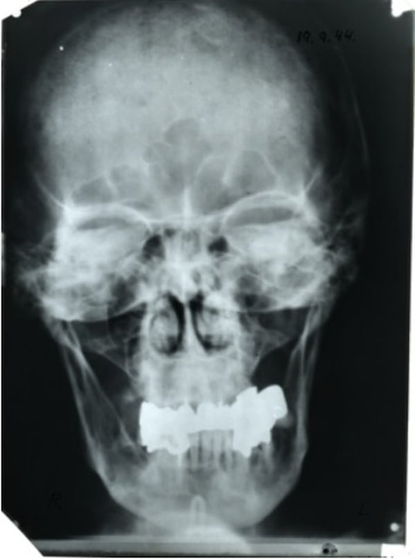 Radiografía de la cabeza de Adolf Hitler. Las partes opacas son prótesis dentales. (National History of Medicine – © Wikimedia Commons). La radiografía fue realizada el 19 de septiembre de 1944.