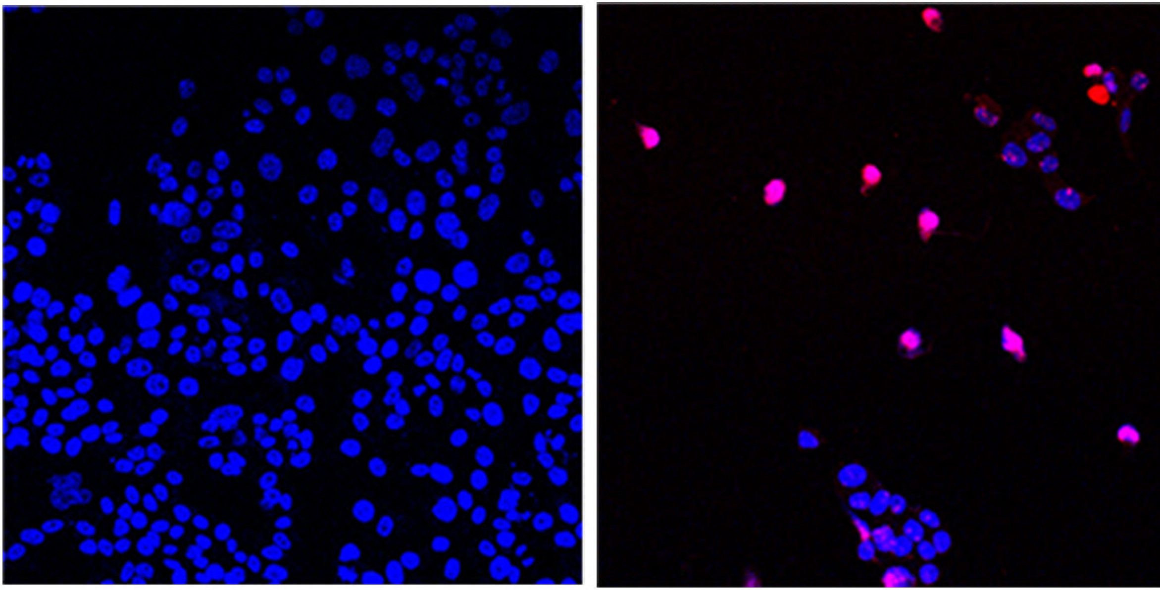 La molécula AOH1996 actúa contra una variante cancerosa de la proteína PCNA. Aquí se ven células cancerosas no tratadas (izquierda) y células cancerosas tratadas con AOH1996 (derecha) sometidas al proceso de muerte celular programada (violeta) (City of Hope)