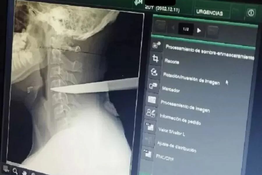 Sobrevivió con un cuchillo clavado en el cuello durante varias horas: el joven resultó herido durante una pelea en Barrancabermeja