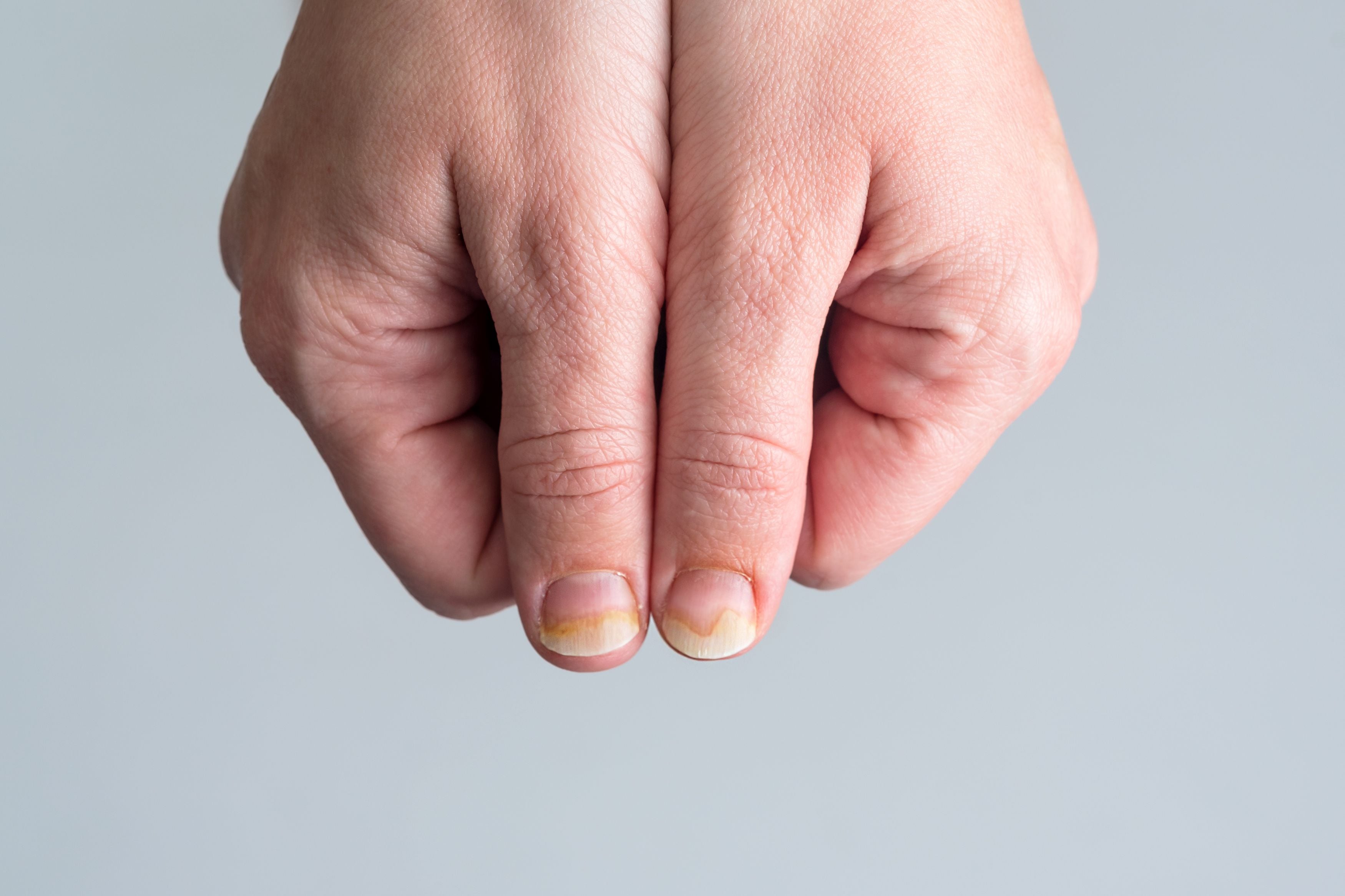La psoriasis puede también afectar debajo de las uñas (Freepik)