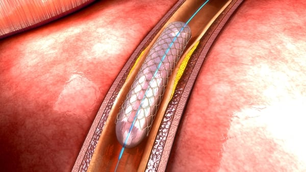 Los stents se emplean en distintos territorios vasculares (Getty)