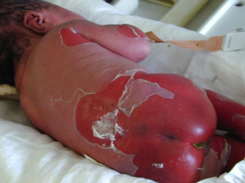 Um gel incrível pode ser a cura para pessoas com doença rara de pele de borboleta, que causa bolhas e quebra de tecido