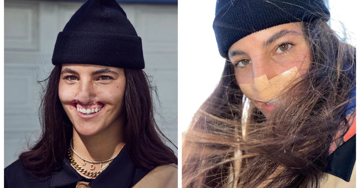 A model lost her lip and part of her nose after being attacked by a pitbull dog
