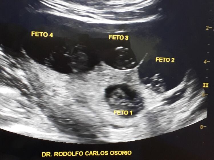 La ecografía donde se ven los cuatro fetos en bolsas distintas. 